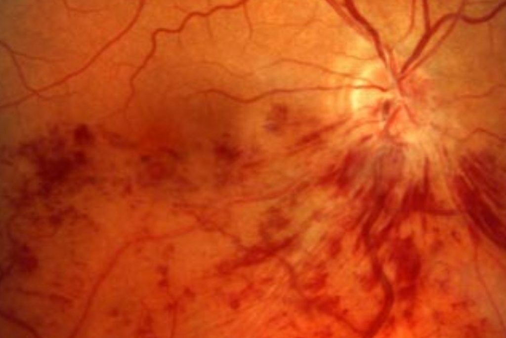 En savoir plus sur la thrombose oculaire - Medinations